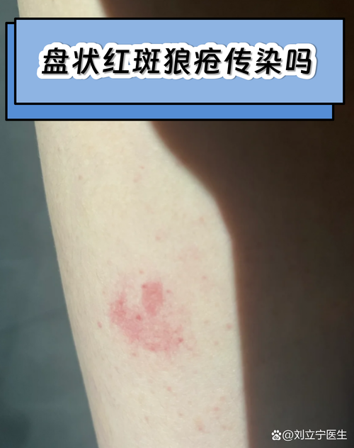 【专家:盘锦市每年或现多个感染高峰,盘锦又有一例疫情了吗】