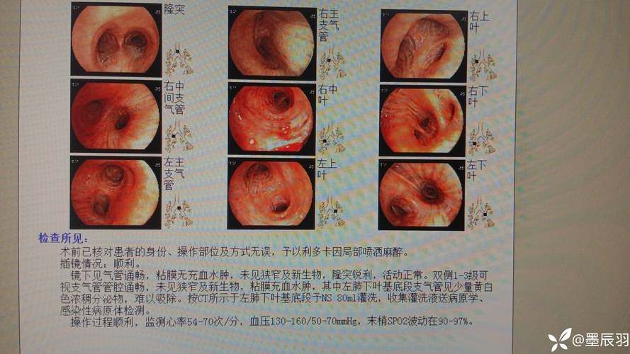 分宜县新增24例阳性感染者及11例无症状_分宜县新型冠状病毒