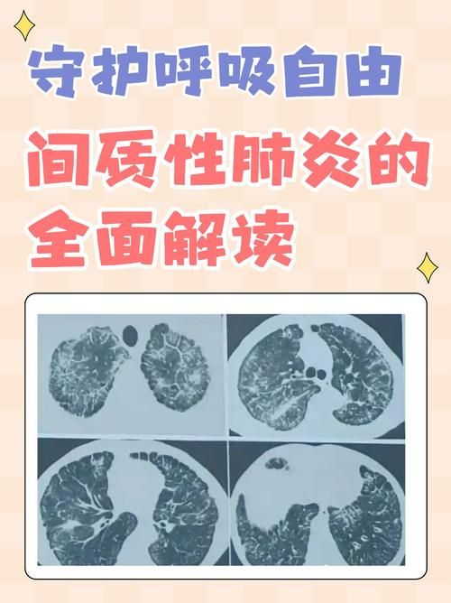 富拉尔基区现有本土确诊6例/富拉尔基区有几例肺炎