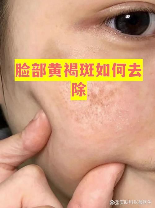  湖北省荆门市京山市最新疫情临床:脸上长黄褐斑看什么科